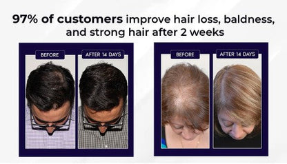 🌿LAST DAY OFFER – 50% OFF🌿 Dougparmo™ Natural Hair Growth Spray